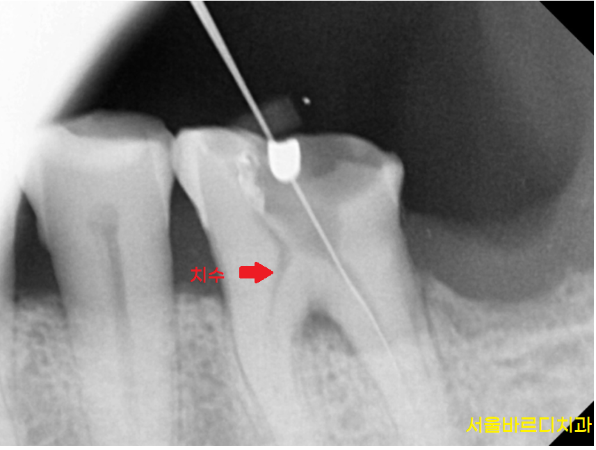 뜨거운 물 시큰 오히려 위험한 신호입니다!! 관련 이미지 3