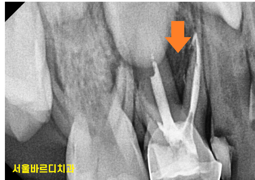 상일동 어린이치과 유치 곧 뽑을 치아이지만 치료가 필요한 이유 관련 이미지 3