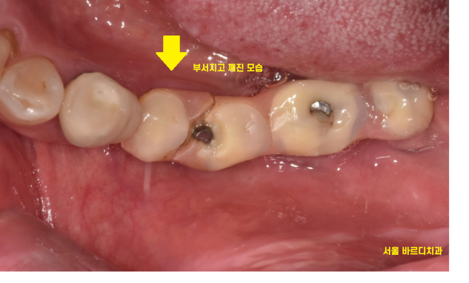 고덕동치과 이가 다 부서졌을 때 임플란트 치료했습니다. 관련 이미지 3