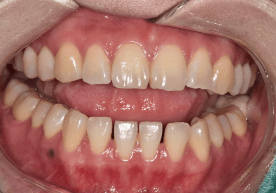 앞니 라미네이트, 치아 시림 고민 덜 수 있는 해결 방법 공개합니다. 관련 이미지 9