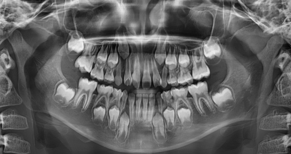 어린이 덧니 교정 걱정되신다면 이 글 꼭 보세요! 적정 시기는? 관련 이미지 4