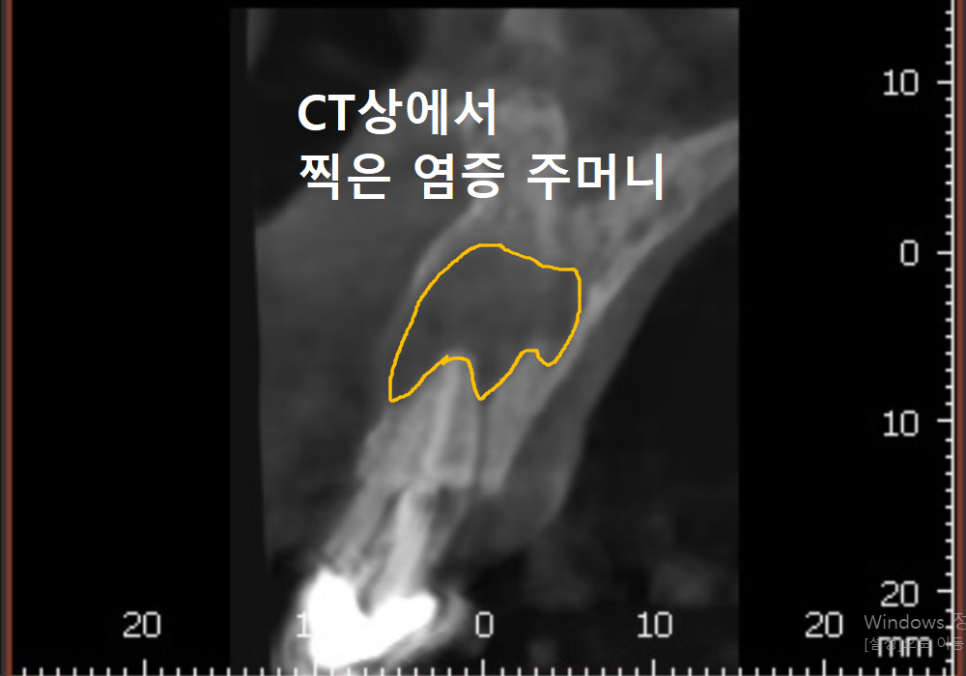 앞니 뿌리 염증, 자연치유될까? 아프지 않아도 치료가 필요한 이유 관련 이미지 6