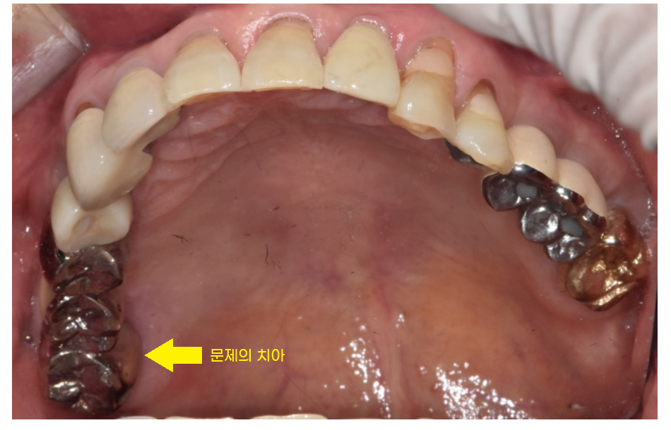 예전에 씌운 이 상악동 거상술 뼈이식 동반하여 임플란트 완료 관련 이미지 3