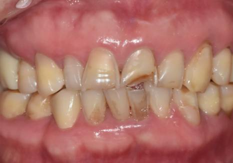 Gangdong-gu Dental Impressions: Are You Still Biting Down for 5 Minutes? We’ll Make It Comfortable with an Intraoral Scanner! image 7