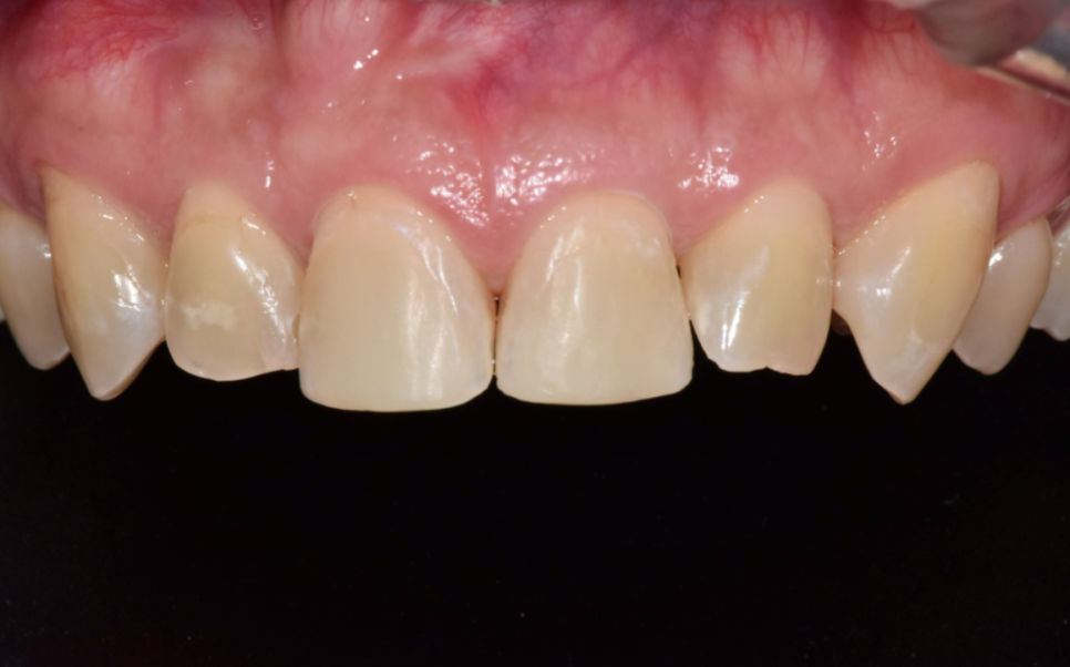 앞니 깨졌을 때, 치아 파절 실비 가능한가요? 관련 이미지 5