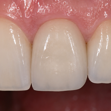 Tooth-Colored Dental Crown Types: PFM and Zirconia (Ziconia) image 5