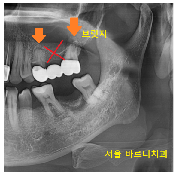 고덕역 근처 치과 브릿지와 임플란트 고민 중이신 분들 클릭하세요 관련 이미지 5