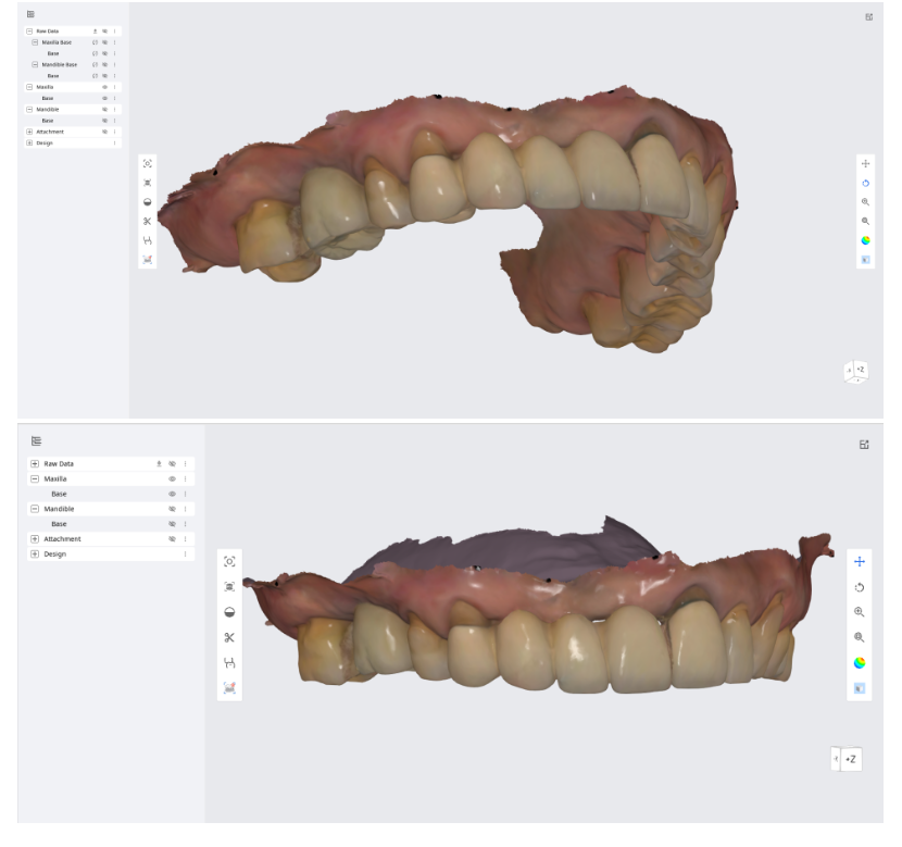 이 뽑고 바로 임플란트 심어도 될까요?? 관련 이미지 3