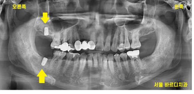 명일동 치과 임플란트 위아래 같이 한꺼번에 할 수 있나요?? 관련 이미지 4