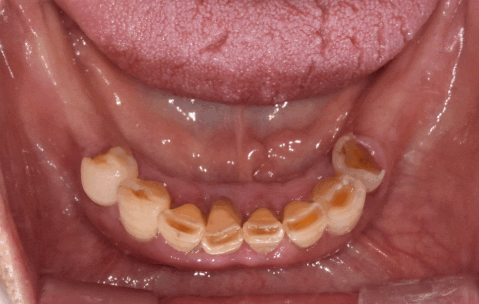 길동 치과 임플란트 틀니 차이 세세하게 대공개 관련 이미지 1