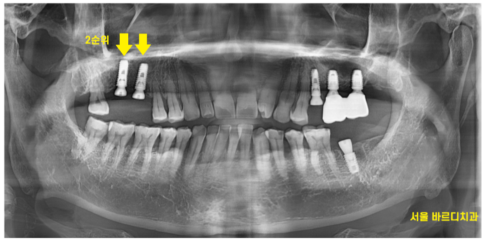 강일동 치과 전남 완도에서 올라오셔서 발치 후 당일 임플란트 완료하였습니다. 관련 이미지 7