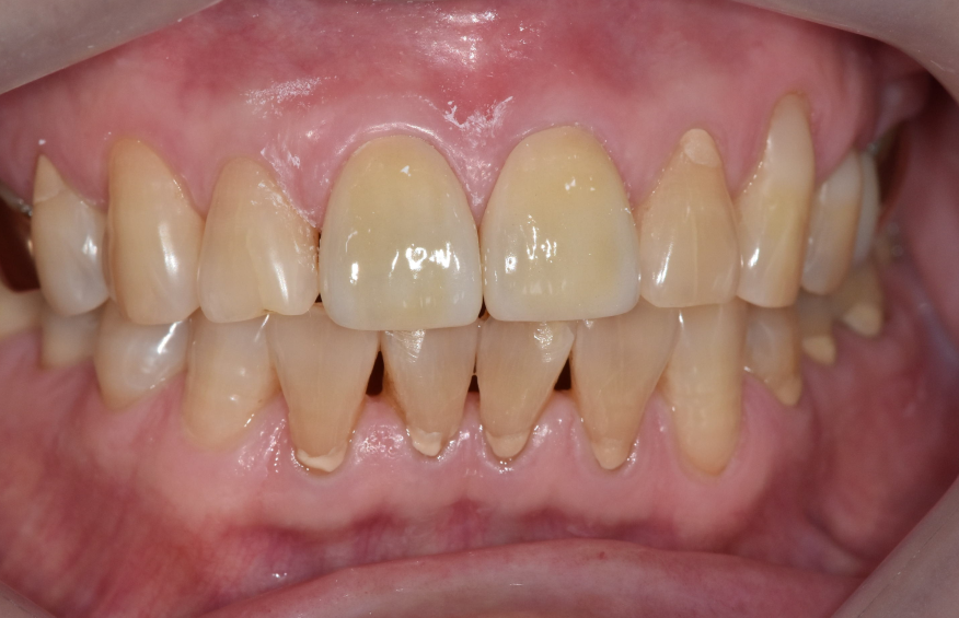 앞니 금 갔을 때, 방치하면 안 되는 진짜 이유 <파절 치료 사례> 관련 이미지 11