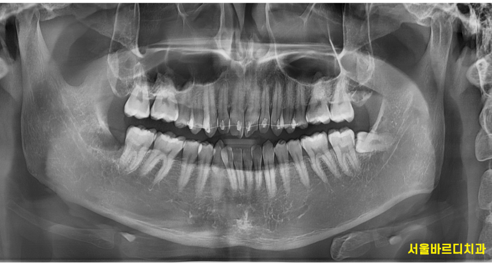 고덕역 근처 교정 치과 치료기간은 얼마나 걸릴까? 관련 이미지 2