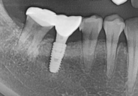 No space for an implant because a tooth has fallen over or a molar has tilted? Read this first. image 2