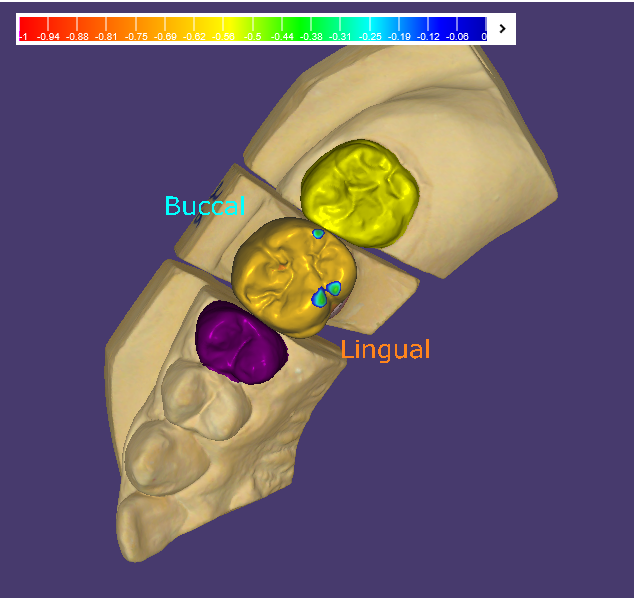 앞니 임플란트, 원내 기공소의 중요성을 아시나요? 관련 이미지 3