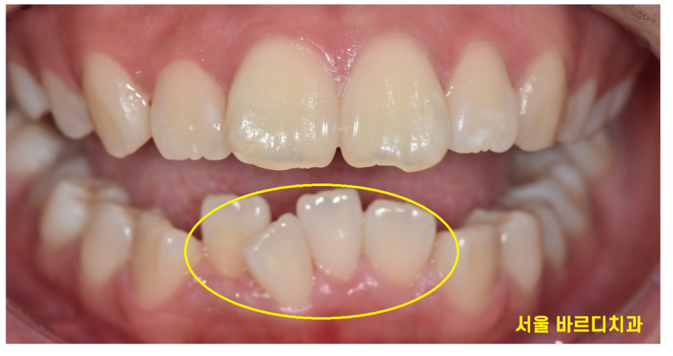 이 안뽑고 교정 안되나요? 발치 교정 케이스를 정리합니다! 관련 이미지 4