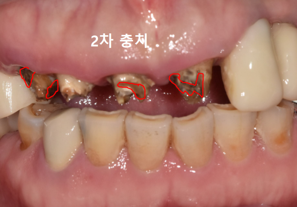 앞니 브릿지 탈락, 씌워둔 게 빠졌어요. 다시 붙일 수 있을까요? 관련 이미지 10