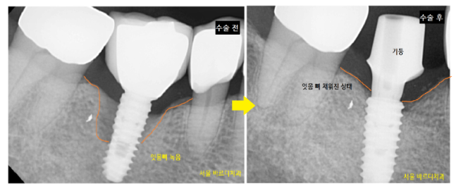 풍산동 치과 임플란트 염증으로 교체 한 환자분 케이스 관련 이미지 8
