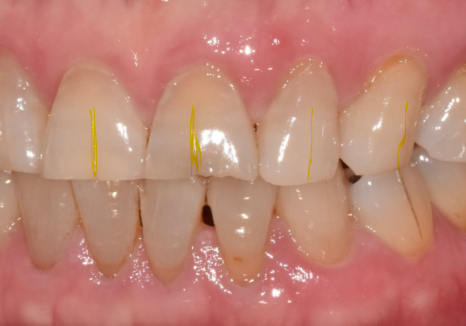 고덕동 앞니 보철, 브릿지와 싱글 크라운, 어떤 선택이 나에게 더 유리할까? 관련 이미지 6