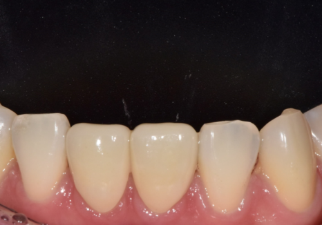 앞니 라미네이트, 치아 시림 고민 덜 수 있는 해결 방법 공개합니다. 관련 이미지 14