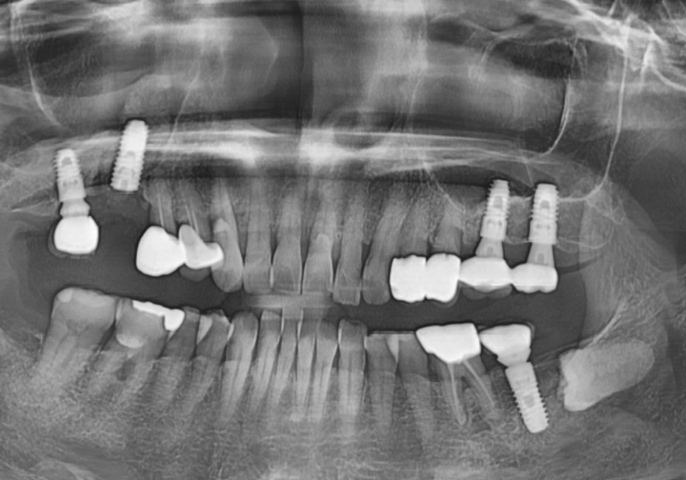 잇몸 고름 눌러보니 푹... 임플란트 주위염 방치했다가 재수술한 사례 관련 이미지 11