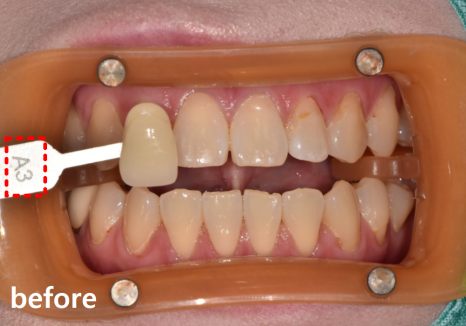 명일동 치과, 미백하면 연예인 치아처럼 새하얘진다는 말, 저는 못하겠습니다. 관련 이미지 11