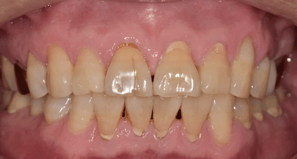 앞니 금 갔을 때, 방치하면 안 되는 진짜 이유 <파절 치료 사례> 관련 이미지 13