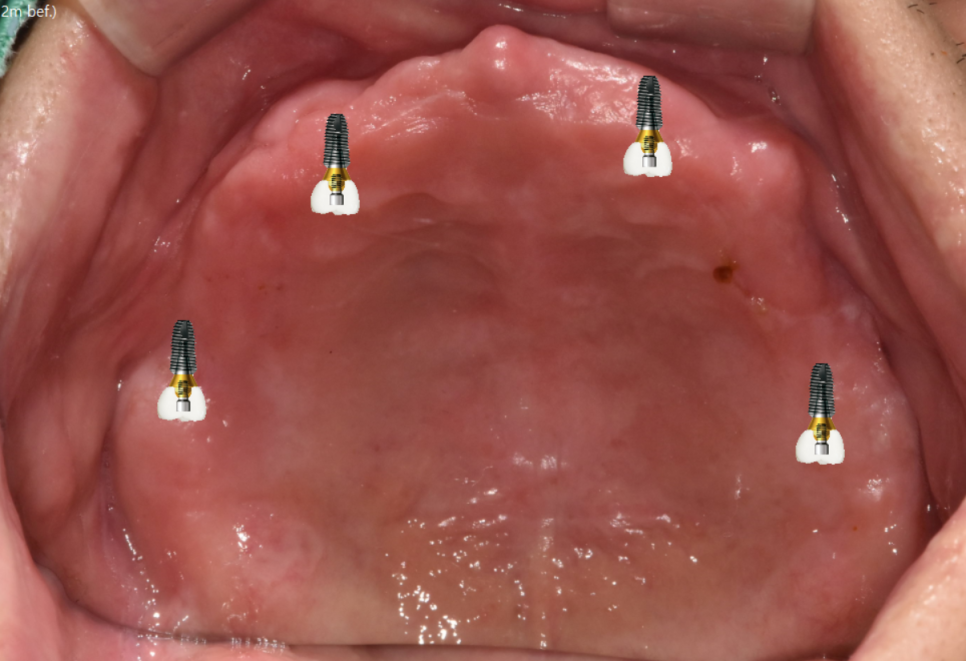고덕역 치과 전체 치아 상실 시 자석 틀니 오버덴쳐가 해답이 될 수 있습니다. 관련 이미지 4