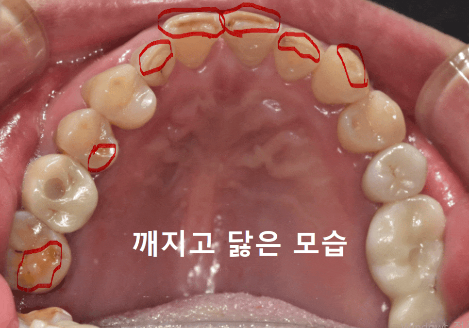 명일동 라미네이트 vs 크라운, 수명을 좌우하는 선택 기준 3가지 관련 이미지 9