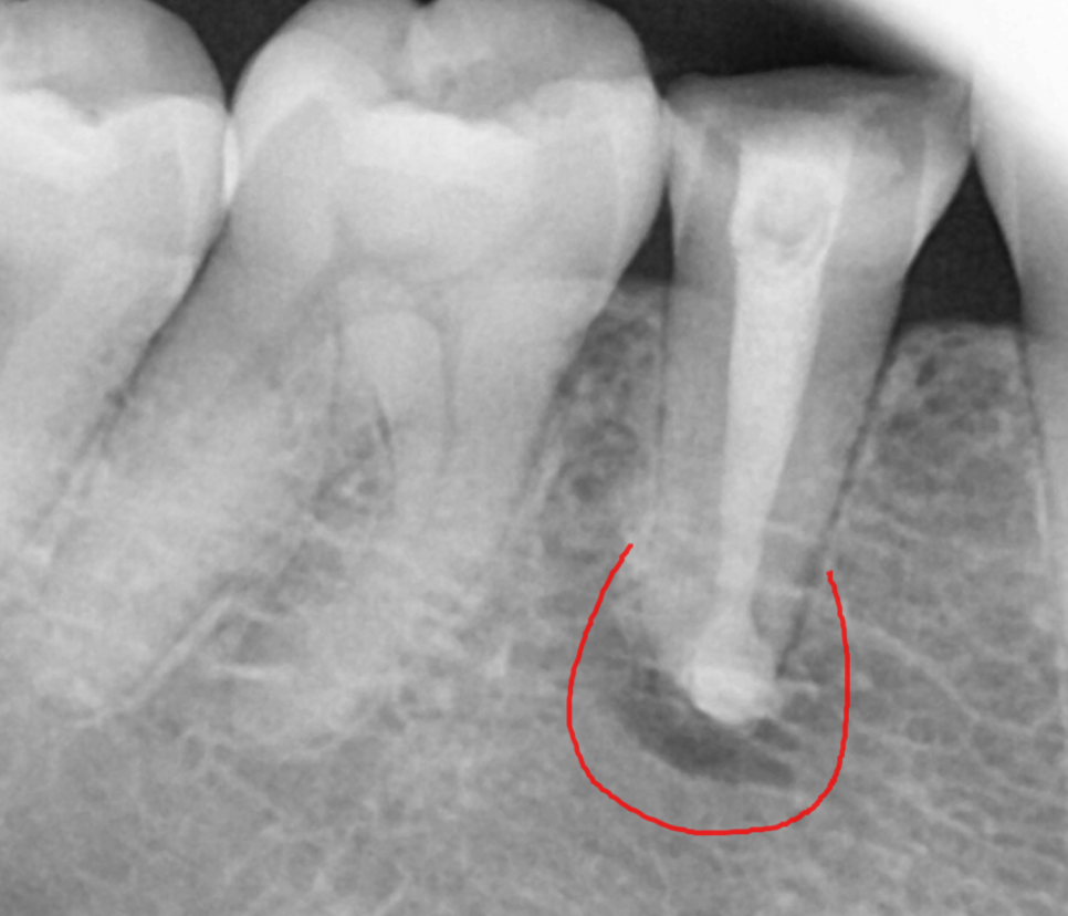 치아 멍 까맣게 변했어요 변색되고 괴사되었을 때 대처법 공개 관련 이미지 5