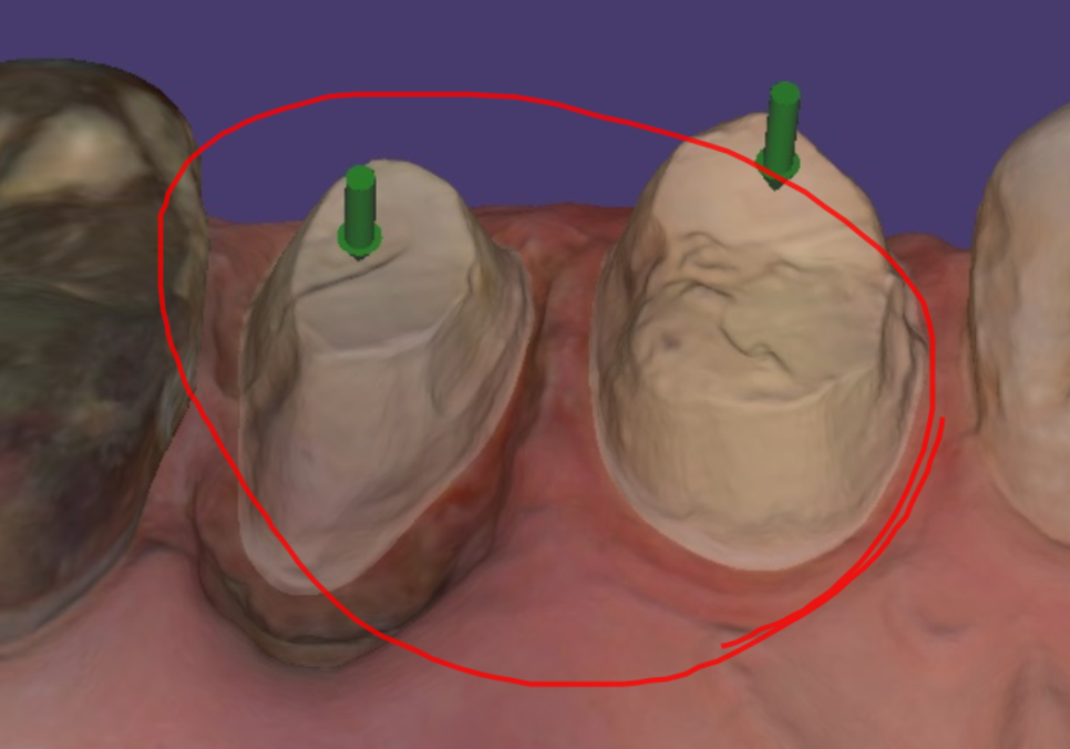 초이동 치과 치아 실금으로 조각나 신경치료까지 진행했습니다. 관련 이미지 8