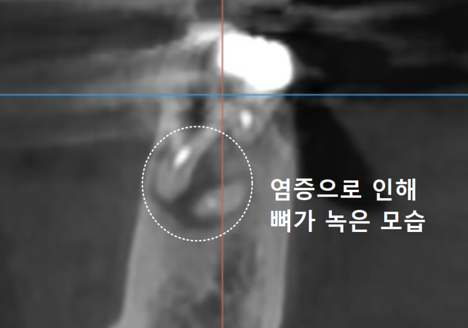 강동구 잇몸 여드름, 이런 상태라면 절대 겉에만 짜는 치료 하지 마세요. 관련 이미지 7