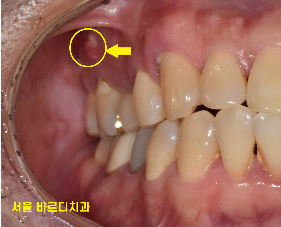 고덕동 치과 잇몸 주저앉음 느낌이 들었다면 늦었을 수도 있습니다. 관련 이미지 4