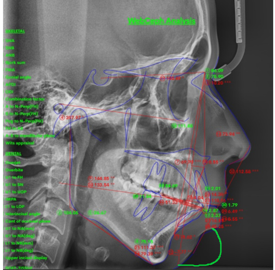Adult Chin Correction: It Can Go Beyond Appearance Issues and Even Disturb You During Sleep image 3