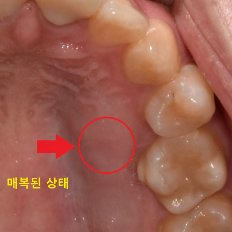 Is a University Hospital the Answer for Extracting a Completely Impacted Tooth? image 3