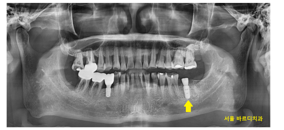 어금니 금감 발치 후 임플란트 풍산동 치과에서 진행했습니다. 관련 이미지 7