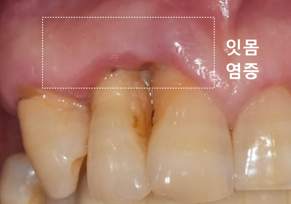 고덕동 스케일링 미루다 앞니 어금니 다 뽑고 임플란트 했습니다. 관련 이미지 2