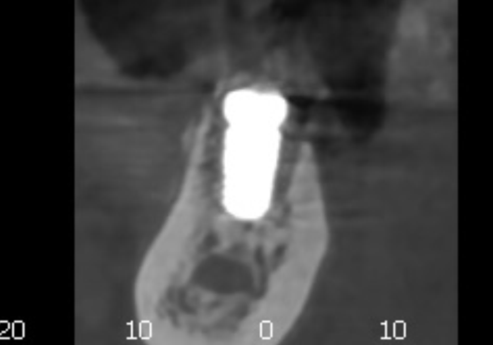 Sangil-dong Station Implant Visits: How Many Times Do You Actually Need to Go to the Dentist? image 6