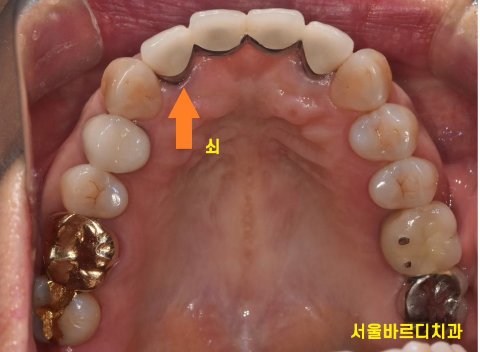앞니 잇몸 검은색 라인 오래된 pfm 보철 교체하세요!! 관련 이미지 5