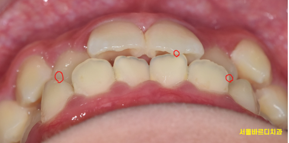 강동구 교정치과 교정 꼭 해야하나요??? 관련 이미지 5