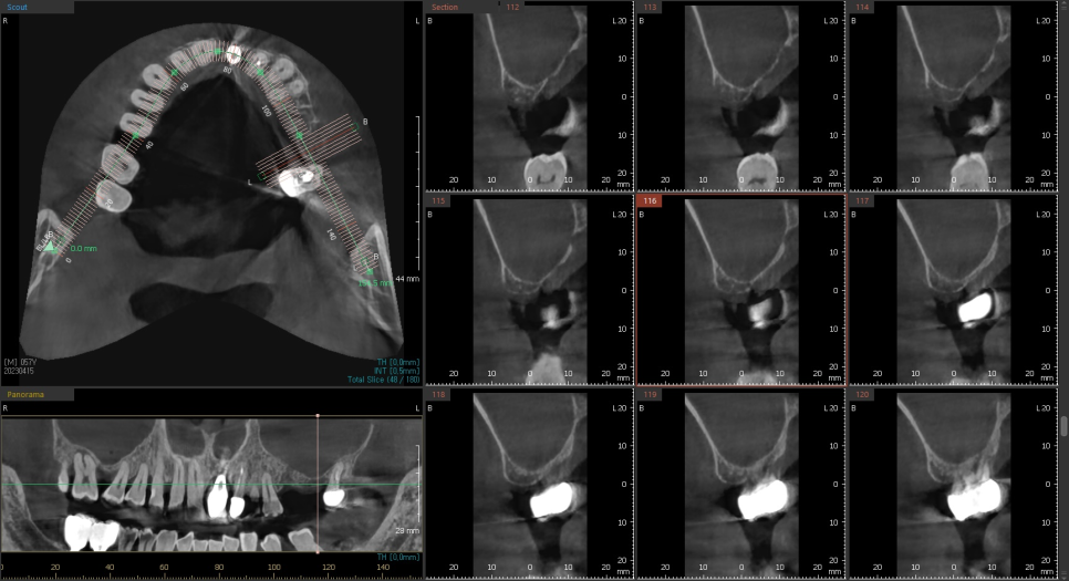 상일동 임플란트 상악동 거상술을 동반한 수술 증례 관련 이미지 4