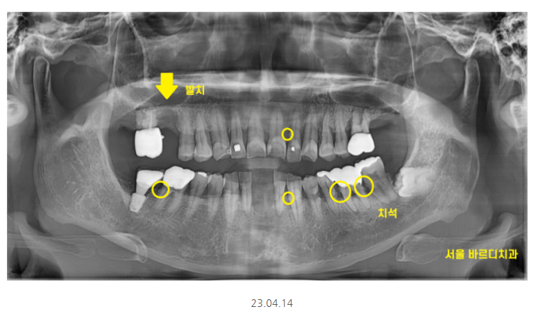 강일동 치과추천 어금니 시림 방치하다 발치하고 임플란트 하신 사연 관련 이미지 4