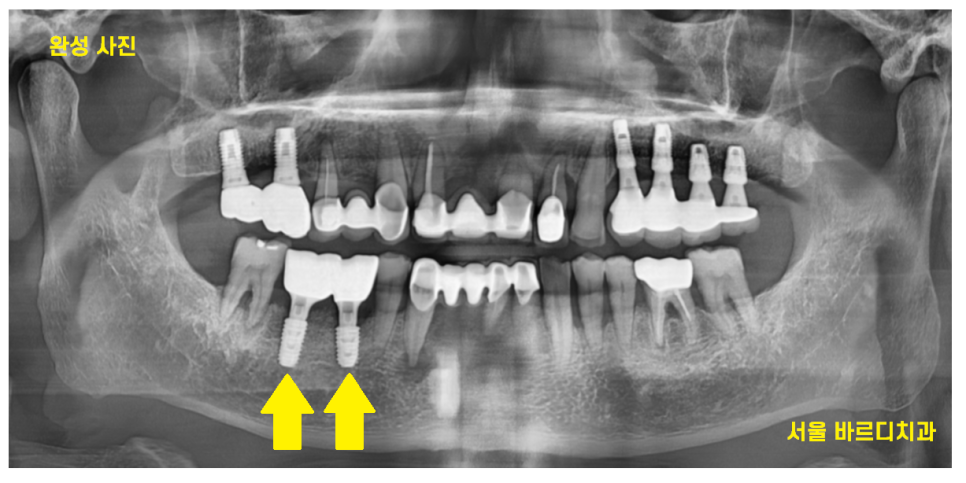 하남시청치과 치아 욱신거림 임플란트로 치료해드렸습니다. 관련 이미지 11