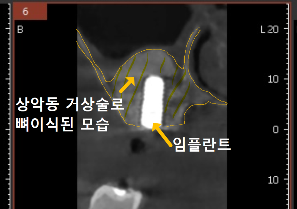 Myeongil-dong Implant Treatment in Your 20s: The Reason It Ended Up Requiring Bone Grafting After Thinking, “I’m Young, So It’ll Be Fine” image 10