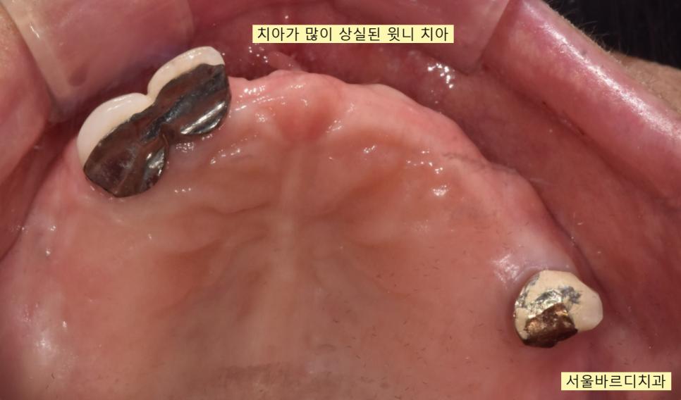 상일동 치과 부분 틀니에서 임플란트 바꿔서 사용하기 관련 이미지 5