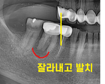하남 임플란트 치과 주문진에서부터 치료 받으러 오신 환자분 관련 이미지 8