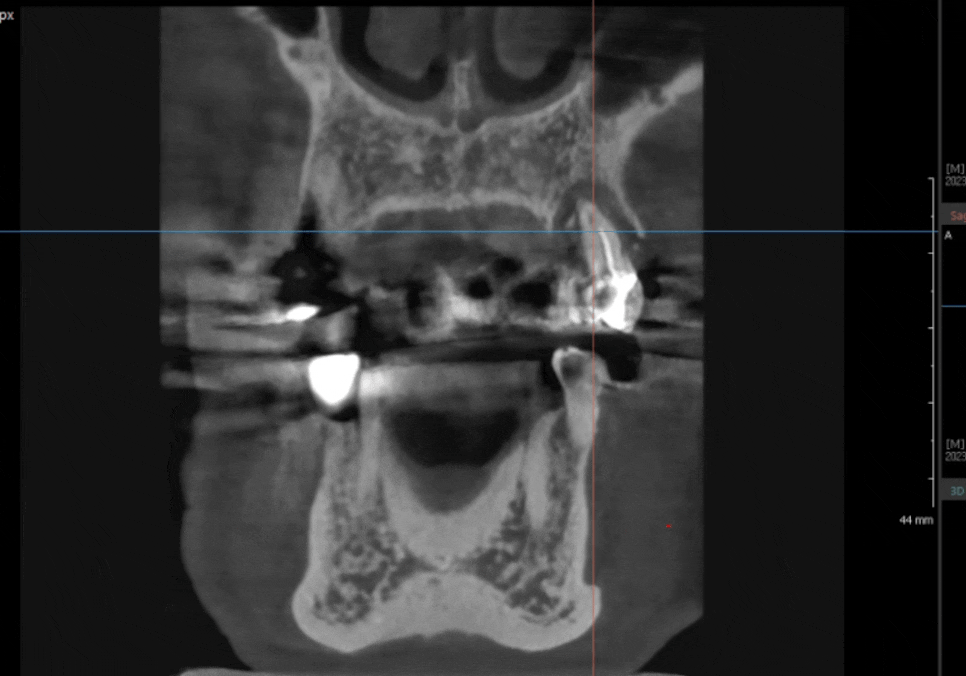 아스피린 복용 중인데 임플란트 수술, 가능할까요? 아스피린 얼마나 끊어야 하나요? 관련 이미지 4