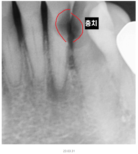 천호동 치과 과잉 진료를 피하는 방법 대공개 관련 이미지 8