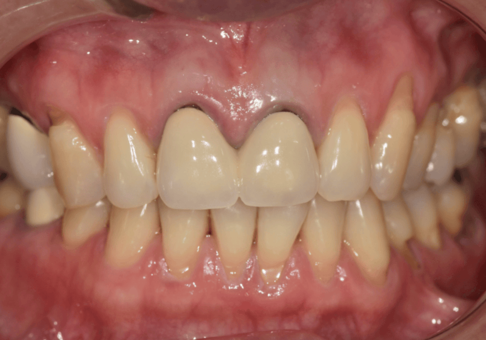잇몸 까매짐 원인,증상,치료 방법 오래전에 앞니 씌운 곳 잇몸이 까매졌어요. 관련 이미지 3