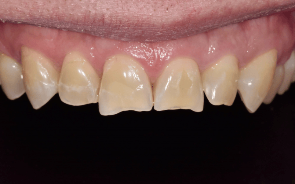 앞니 깨졌을 때, 치아 파절 실비 가능한가요? 관련 이미지 1